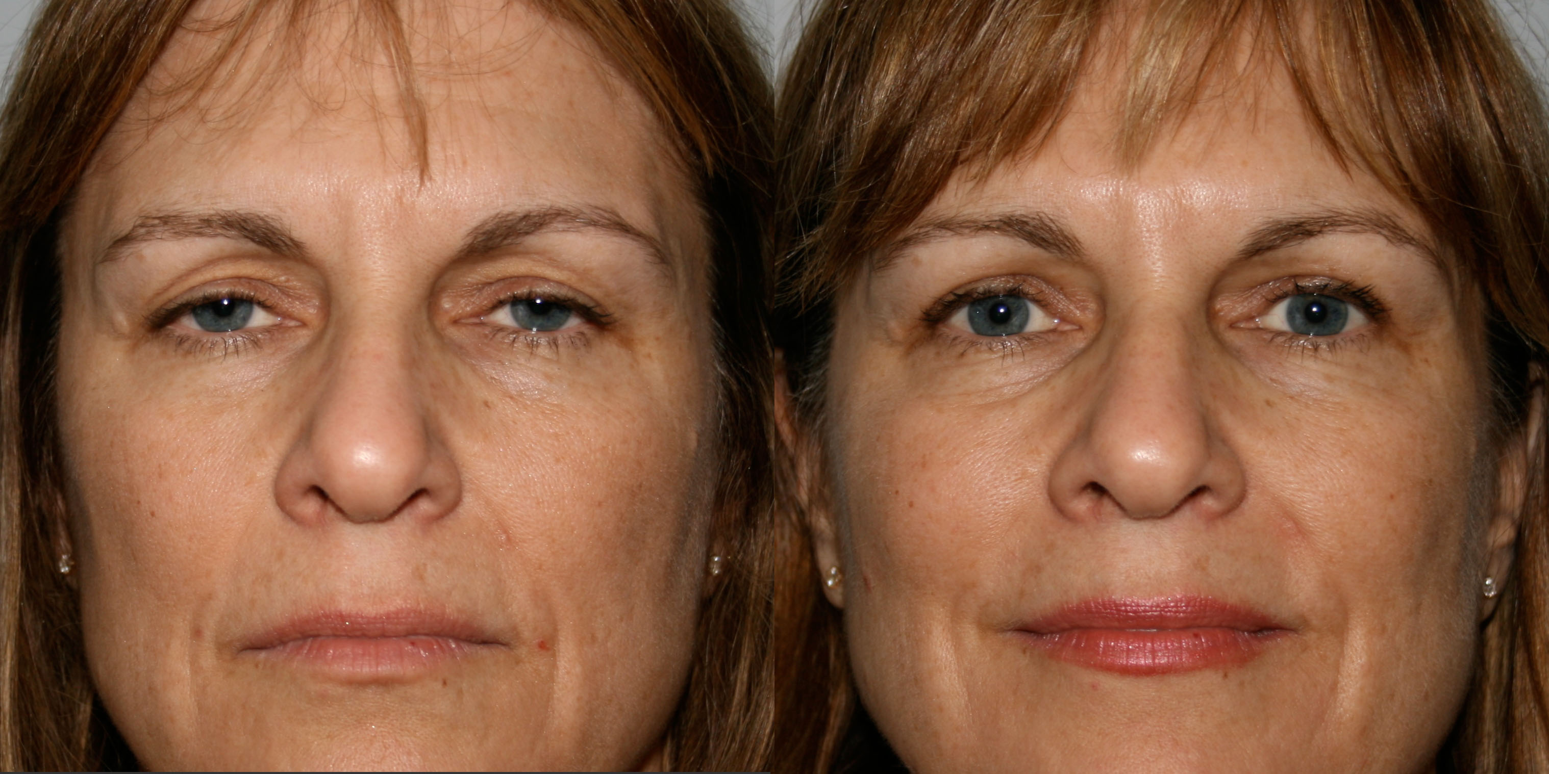 BEFORE AFTER BLEPHAROPLASTY SURGERY before after