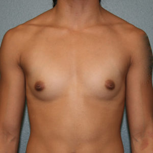 San Diego Magazine Top Doctors Gummy Bear Breast Implants
