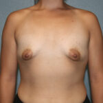 Breast Augmentation