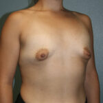 Breast Augmentation