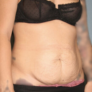 Tummy Tuck