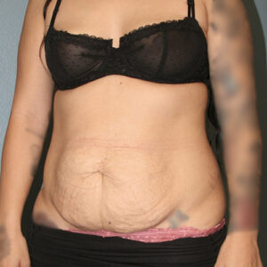 Tummy Tuck