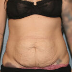 Tummy Tuck