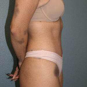 Tummy Tuck