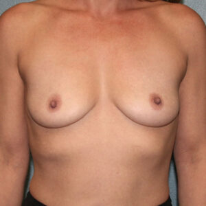 Breast Augmentation