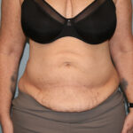 Tummy Tuck