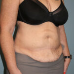 Tummy Tuck