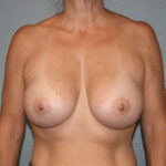 Breast Augmentation