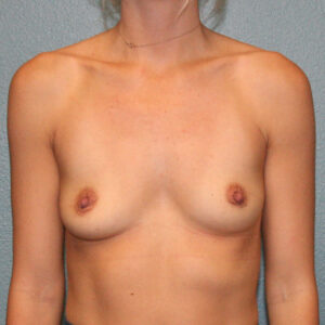 Breast Augmentation