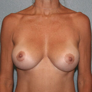 Breast Augmentation